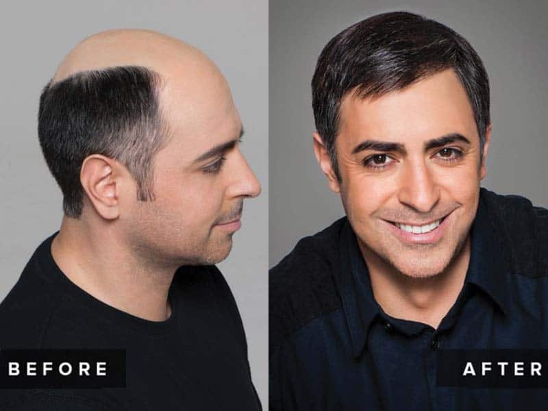 Signs Of Balding - How To Know If You're Going Bald?